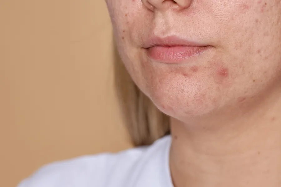 Acne Hormonal: 7 Tratamentos e Como Identificar as Causas