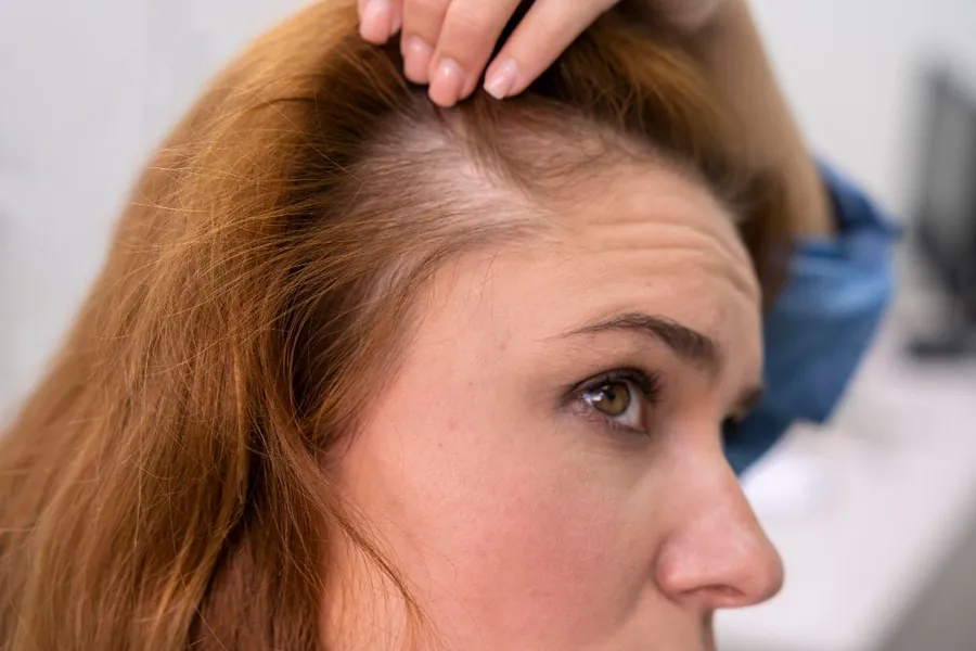 Alopecia Frontal Fibrosante: Sinais, Causas e 6 Tratamentos