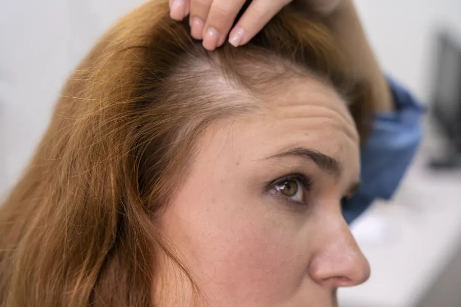 Alopecia: 6 Tipos de Queda de Cabelo e Seus Tratamentos
