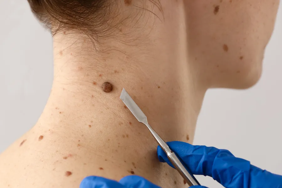 Câncer de Pele: Como Identificar, Prevenir e Tratar