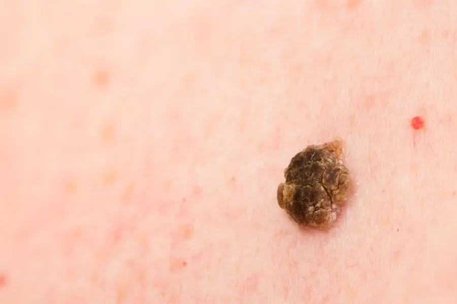 Ceratose Seborreica: O que É, Causas e 5 Tratamentos Dermatológicos