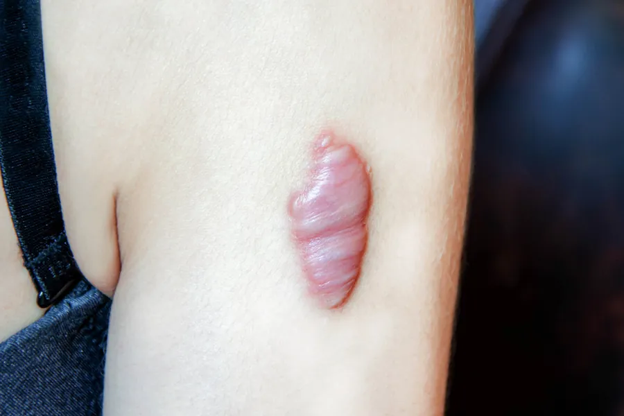 Cicatriz Hipertrófica e Queloide: Diferenças e 5 Tratamentos Dermatológicos