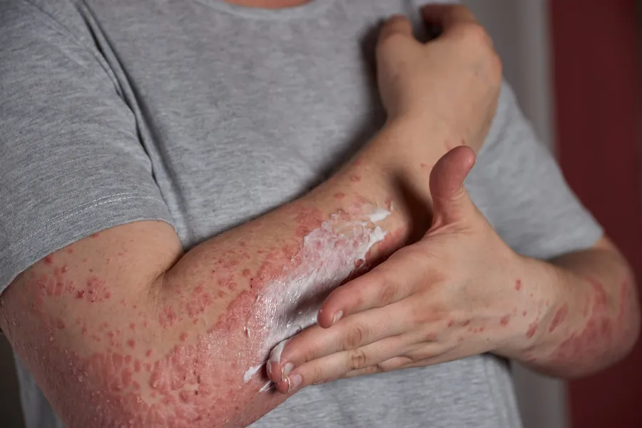 Dermatite Atópica: 7 Coisas Que Você Precisa Saber