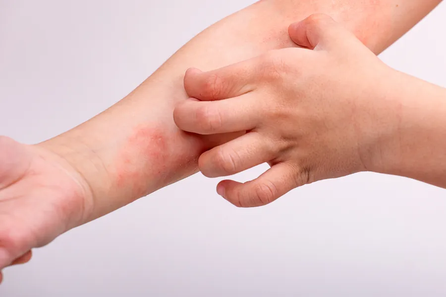 Dermatite Numular: Causas, Sintomas e 4 Tratamentos Eficazes