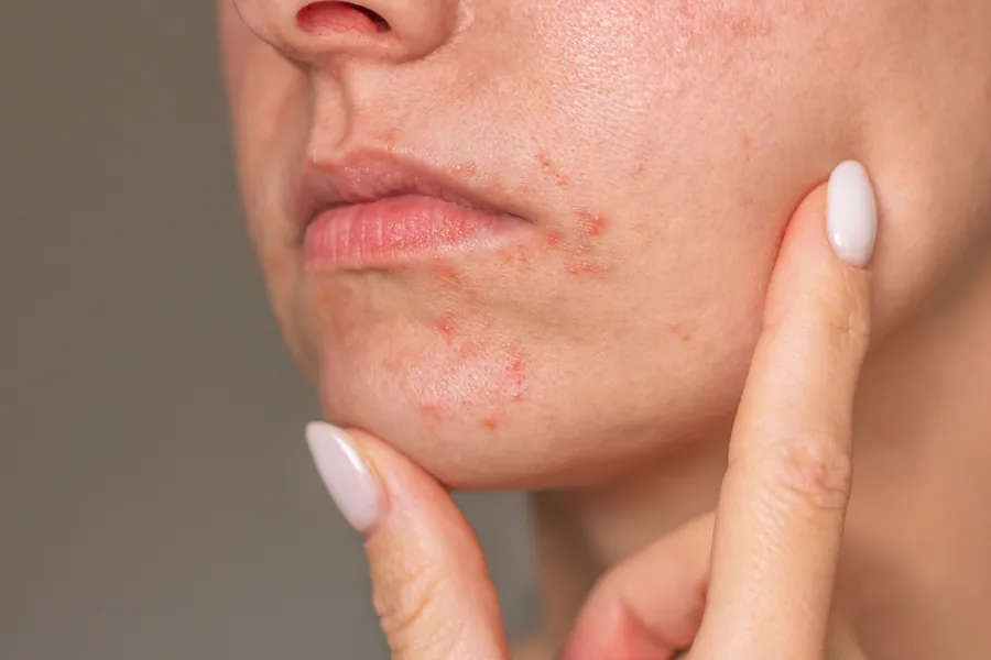 Dermatite Perioral: Causas, Sintomas e 6 Tratamentos Dermatológicos