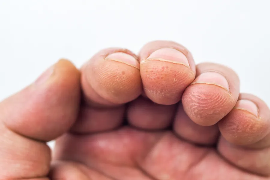 Disidrose (Eczema Dishidrótico): Causas, Sintomas e 5 Tratamentos