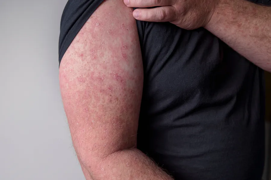 Erisipela: Causas, Sintomas e Tratamentos Dermatológicos