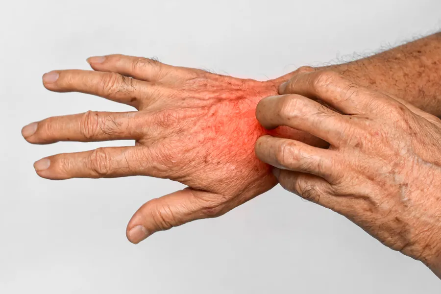 Escabiose (Sarna): 3 Tipos, Sintomas e 5 Tratamentos Dermatológicos
