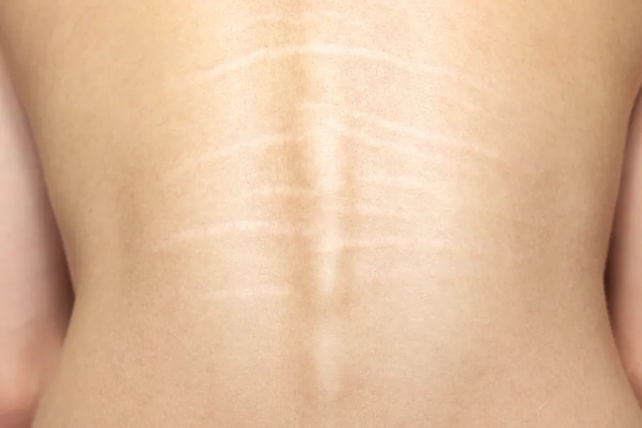 Estrias: Tipos, Causas e 6 Tratamentos Dermatológicos Eficazes