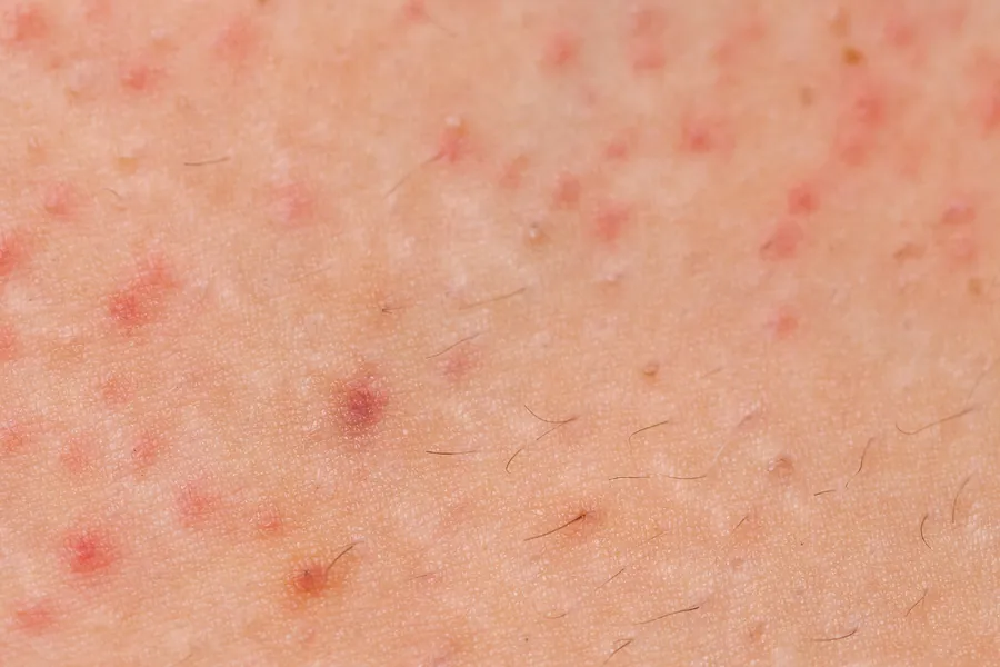 Foliculite: 5 Tipos, Causas e Tratamentos Dermatológicos