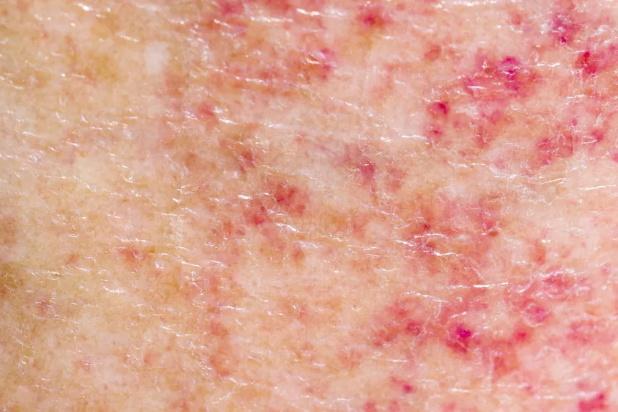 Fotodermatose: 5 Tipos de Alergia Solar, Causas e Tratamentos