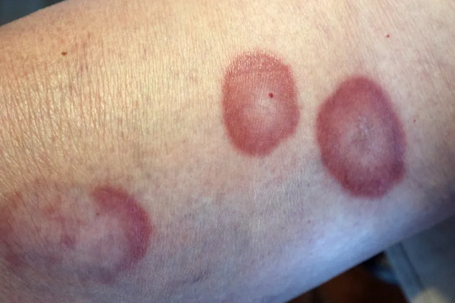 Granuloma Anular: 5 Tipos, Causas e Tratamentos Dermatológicos