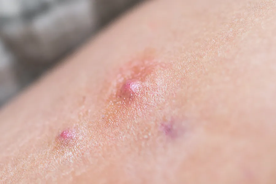 Hidradenite Supurativa: Causas, 4 Estágios e Tratamentos Dermatológicos