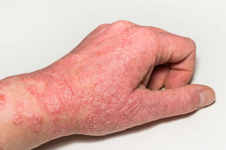 Líquen Plano: 5 Tipos, Sintomas e Tratamento Dermatológico