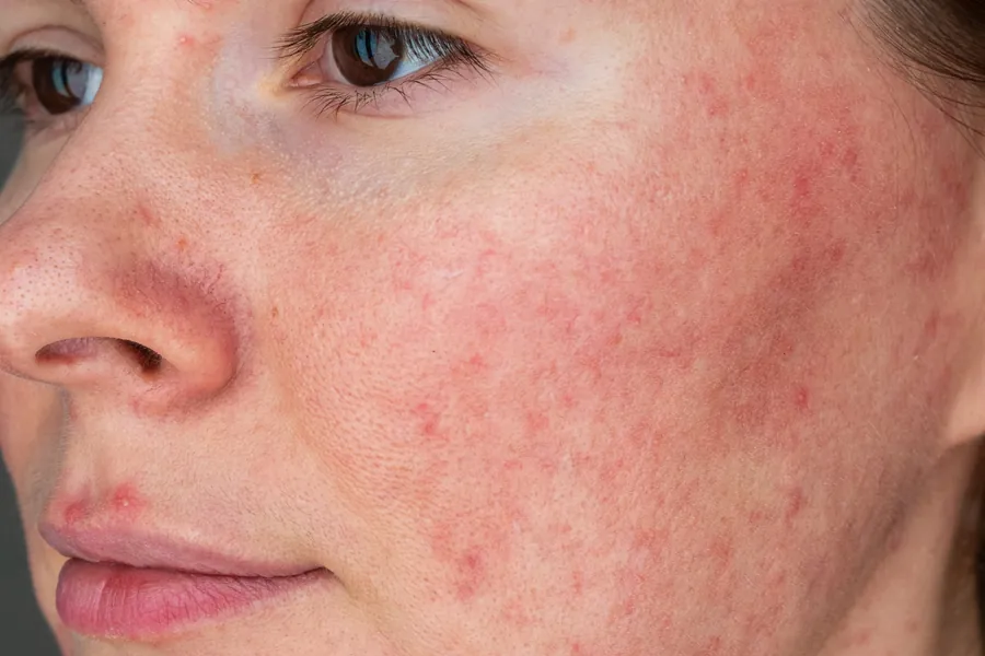 Lúpus Eritematoso Cutâneo: 4 Tipos, Sintomas e 6 Tratamentos