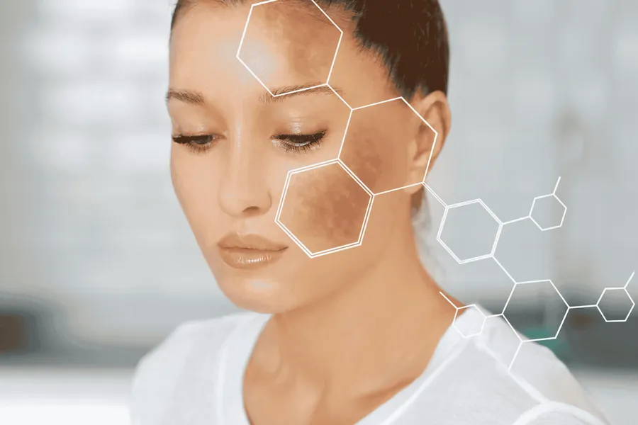 Melasma: Causas, Tratamentos e Como Prevenir Manchas na Pele