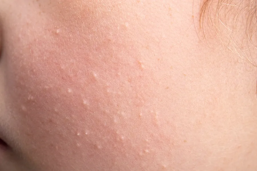 Mília (Milium): 4 Tipos, Causas e Tratamentos Dermatológicos Eficazes