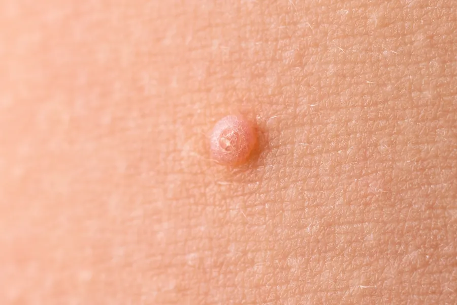 Molusco Contagioso: 6 Tratamentos para Crianças e Adultos