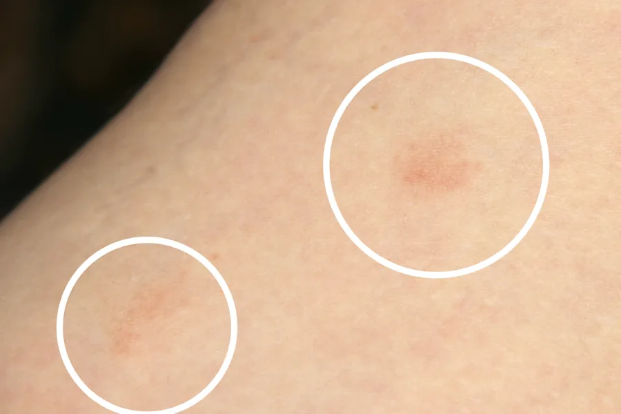 Pitiríase Rósea: Causas, Sintomas e Tratamento Dermatológico