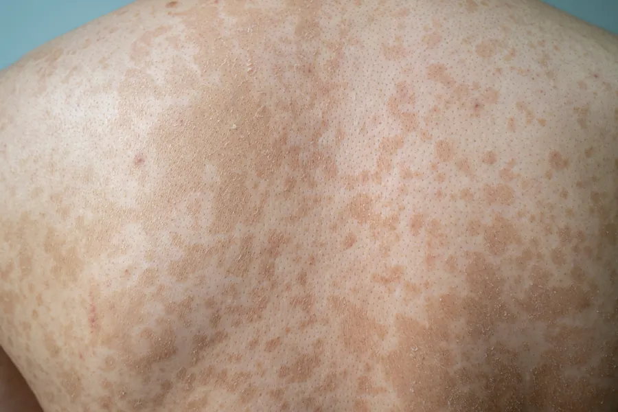 Pitiríase Versicolor: Causas, 3 Tipos de Manchas e Tratamentos