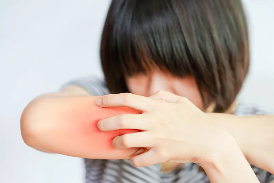 Prurigo Nodular: Causas, Sintomas e Tratamentos Dermatológicos