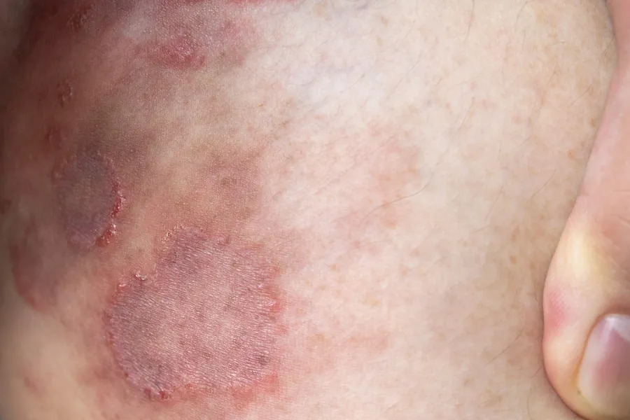 Tinea: 4 Tipos de Micose na Pele, Causas e Tratamentos