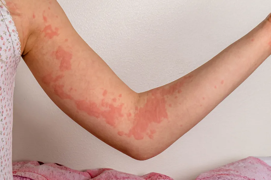 Urticária: 6 Tipos, Causas e Tratamentos Dermatológicos