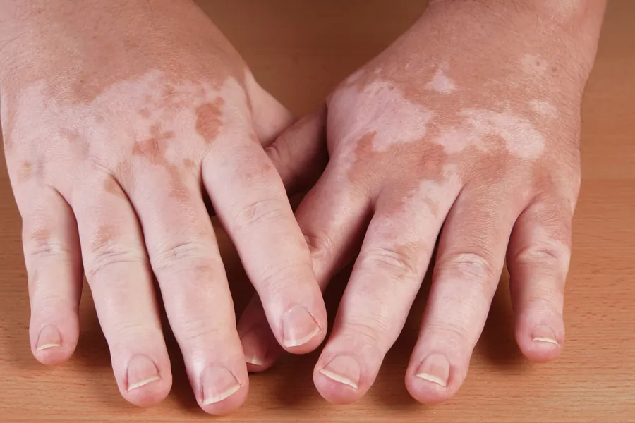 Vitiligo: 5 Coisas Que Você Precisa Saber Sobre a Doença